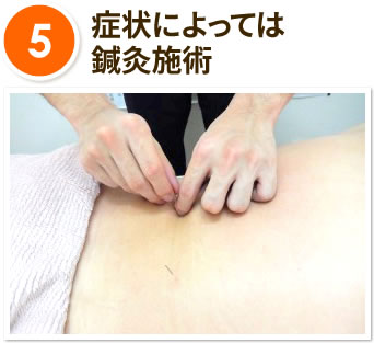 5.症状によっては鍼灸施術